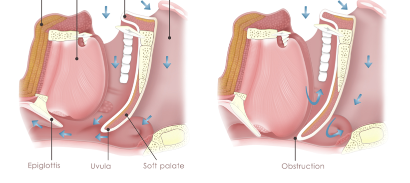 What is Obstructive Sleep Apnea (OSA)?